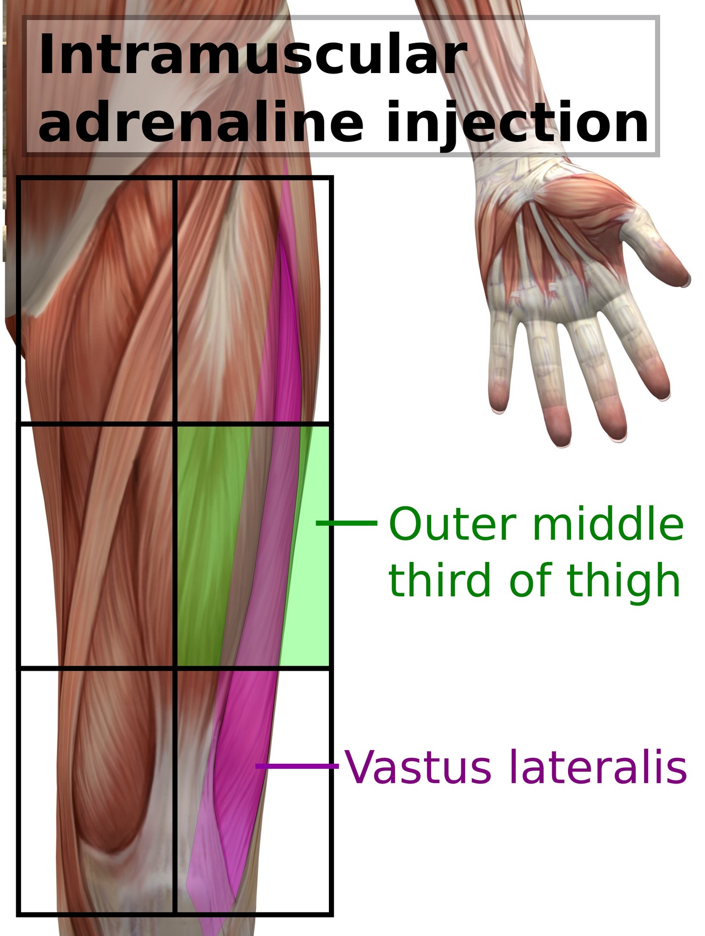 The intramuscular injection site on the outer middle third of the thigh, over the vastus lateralis.