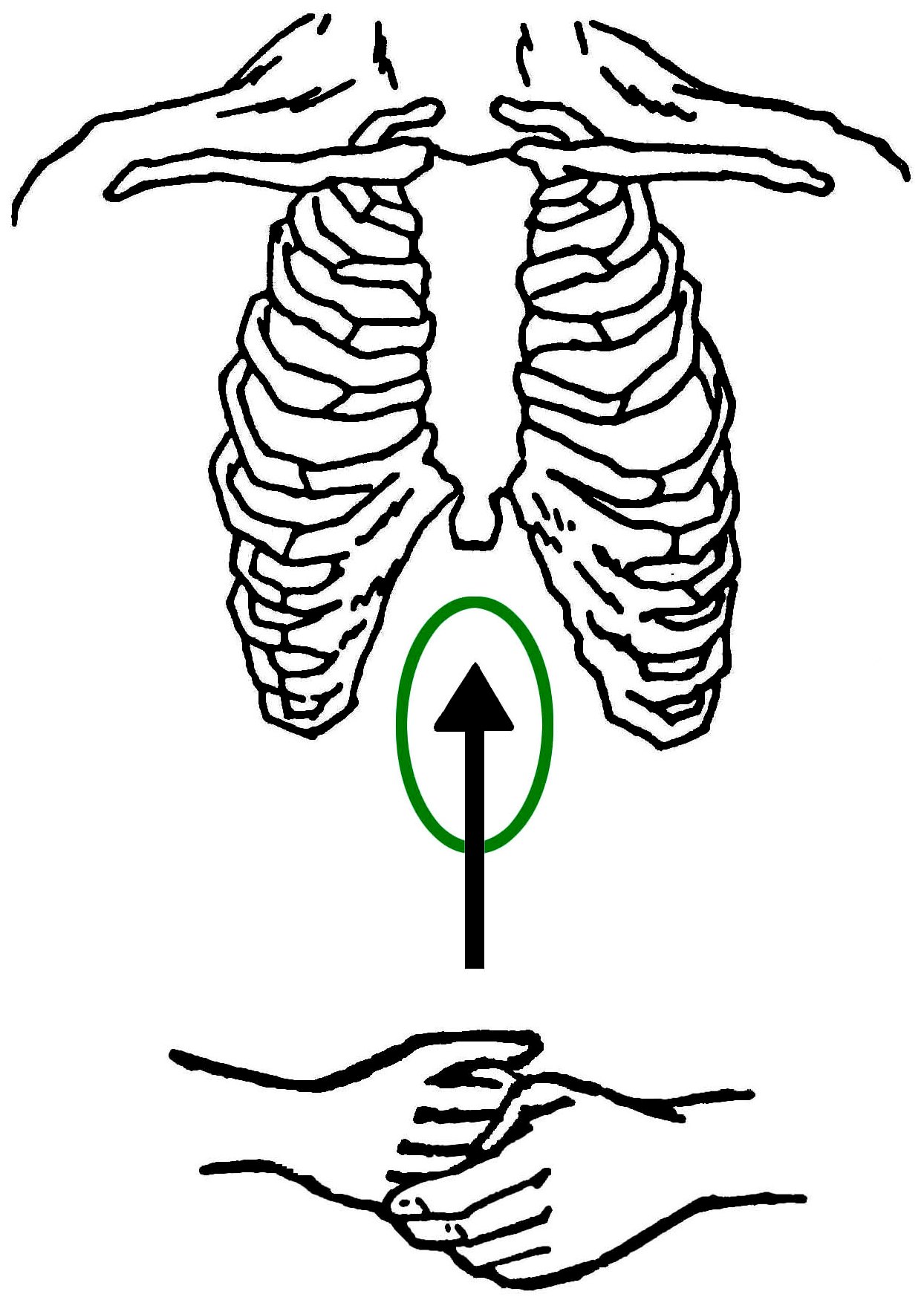 Abdominal thrusts: a fist in the midline of the upper abdomen, just above the navel, thrusting upward.