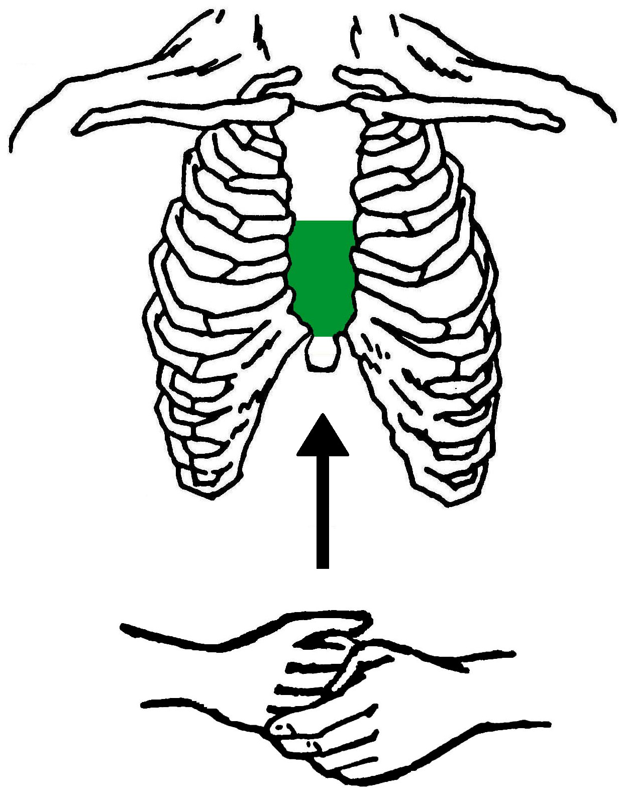 Chest thrusts land on the lower half of the sternum, the same area as chest compressions.