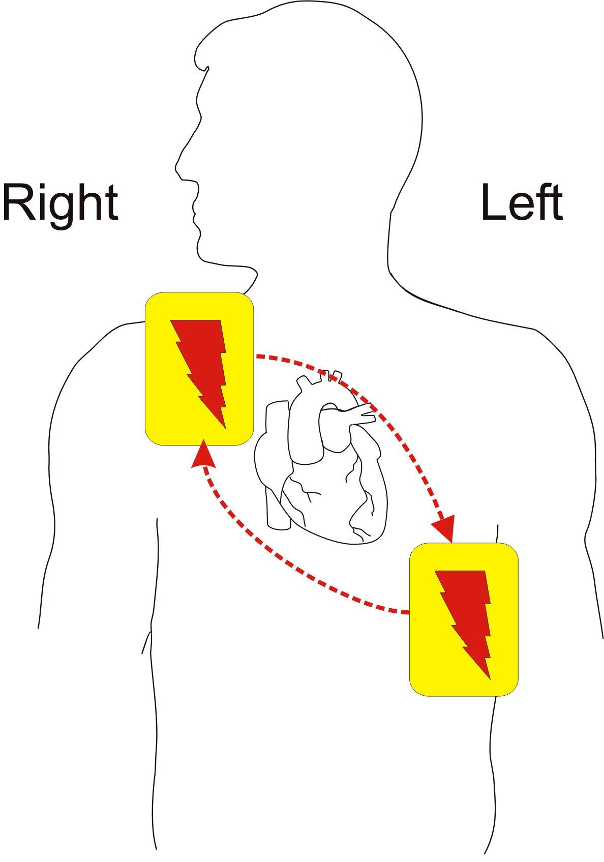Anterolateral defibrillator pads. One pad is on the right upper chest and the other is on the left side of the chest.