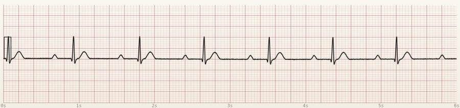 CardioStrip example: first-degree AV block