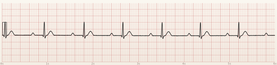 CardioStrip example: first-degree AV block
