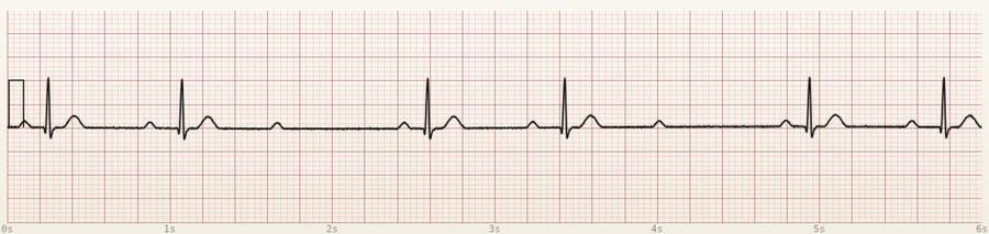 CardioStrip example: Mobitz I