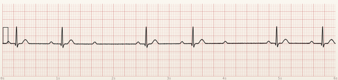 CardioStrip example: Mobitz I