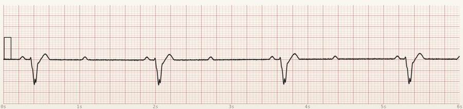 CardioStrip example: Mobitz II