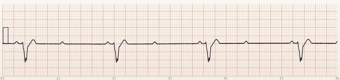 CardioStrip example: Mobitz II