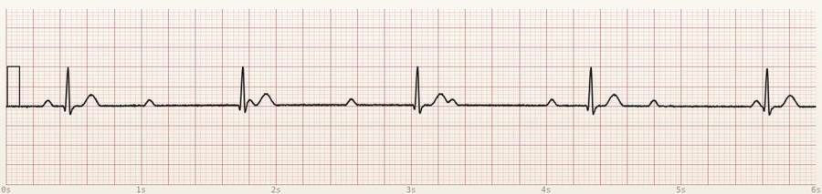 CardioStrip example: third-degree block