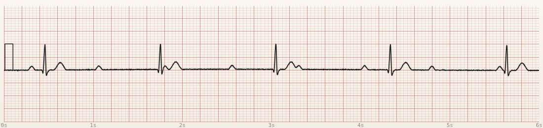 CardioStrip example: third-degree block